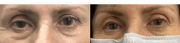 Ptosis Repair Before After Image