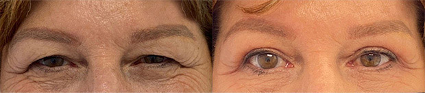 58 year old woman who was bothered by her upper eyelid appearance. She underwent in-office upper eyelid blepharoplasty and internal browpexy. After photos show results at 1 month post-surgery. Results can last 10 years.
