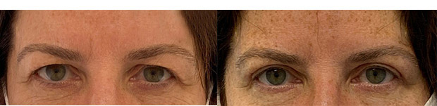 55 year old woman who was bothered by her upper eyelid appearance. She underwent upper eyelid blepharoplasty and internal browpexy. After photos show results at 3 months post-surgery.