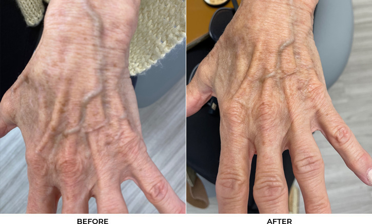 69 year old woman bothered by discoloration on the hands. After photos obtained 2 months after a single BBL treatment.				