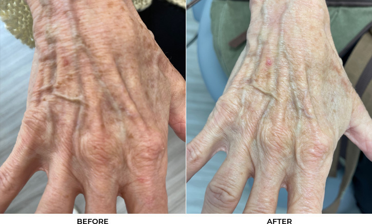 69 year old woman bothered by discoloration on the hands. After photos obtained 2 months after a single BBL treatment.				