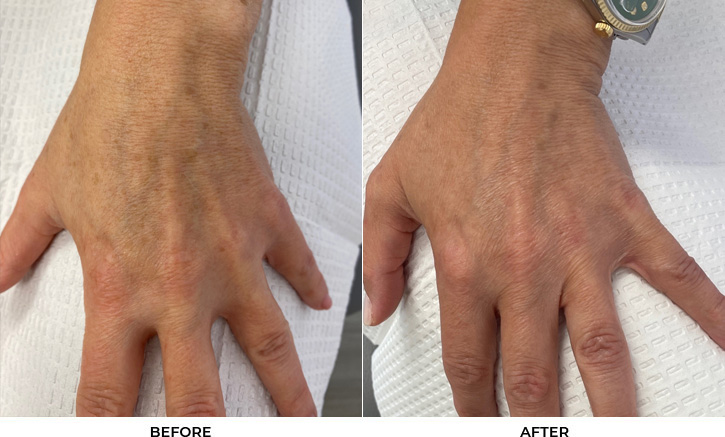 49 year old woman bothered by discoloration on the hands. After photos obtained 2 months after a single BBL treatment.				