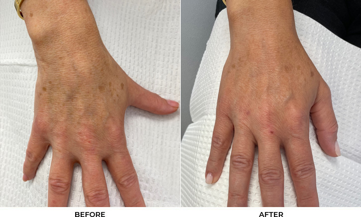 49 year old woman bothered by discoloration on the hands. After photos obtained 2 months after a single BBL treatment.				