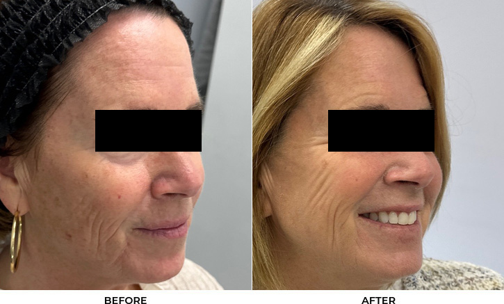 60 year old woman bothered by discoloration on the face. After photos obtained 3 months after a single BBL treatment.				