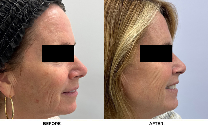 60 year old woman bothered by discoloration on the face. After photos obtained 3 months after a single BBL treatment.				