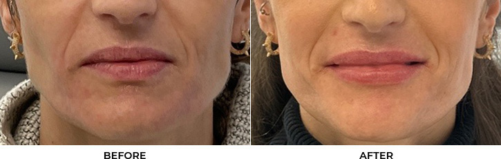 45 year old woman who was bothered by lip volume loss and asymmetry. She underwent upper blepharoplasty and lip filler placement for lip augmentation. After photos are immediately post-lip filler treatment.				