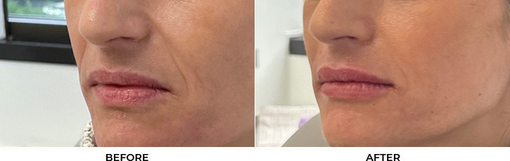 45 year old woman who was bothered by lip volume loss and asymmetry. She underwent upper blepharoplasty and lip filler placement for lip augmentation. After photos are immediately post-lip filler treatment.				