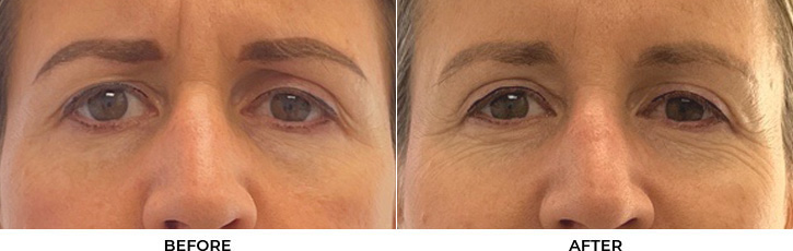 51 year old woman who was bothered by her upper eyelid appearance. She underwent upper eyelid blepharoplasty and internal browpexy. After photos show results at 3 months post-surgery.				