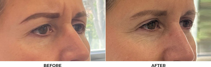 51 year old woman who was bothered by her upper eyelid appearance. She underwent upper eyelid blepharoplasty and internal browpexy. After photos show results at 3 months post-surgery.				