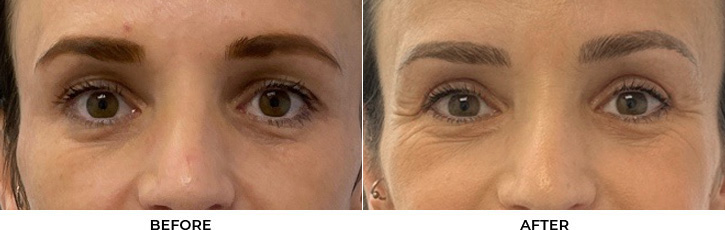 45 year old woman who was bothered by her upper eyelid appearance. She underwent upper blepharoplasty. After photos are 3 months post-surgery.				