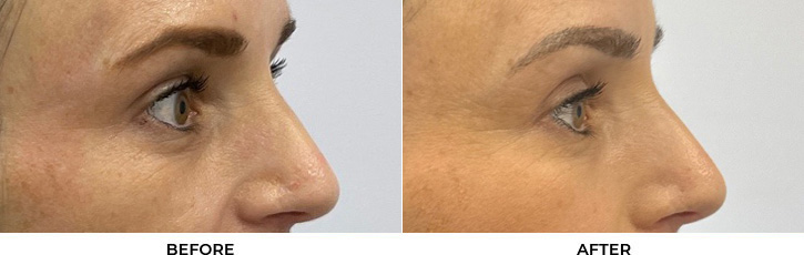 45 year old woman who was bothered by her upper eyelid appearance. She underwent upper blepharoplasty. After photos are 3 months post-surgery.				