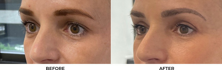 45 year old woman who was bothered by her upper eyelid appearance. She underwent upper blepharoplasty. After photos are 3 months post-surgery.				