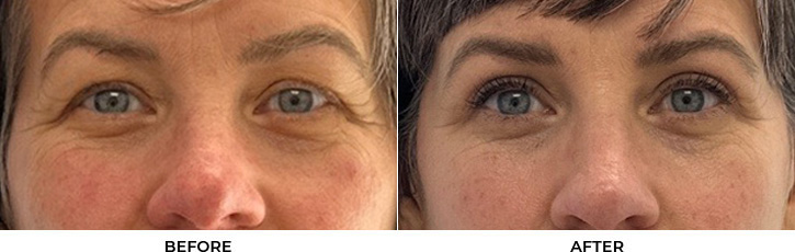 53 year old woman who was bothered by her upper eyelids appearance. She underwent upper blepharoplasty. After photos are 3 months post-surgery.				