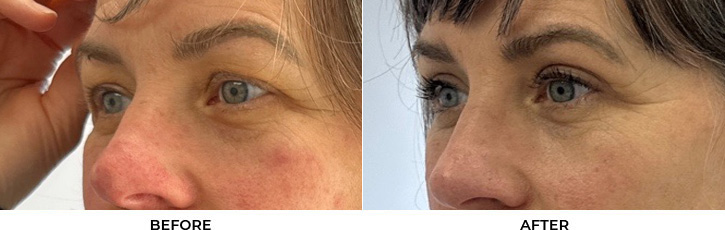 53 year old woman who was bothered by her upper eyelids appearance. She underwent upper blepharoplasty. After photos are 3 months post-surgery.				