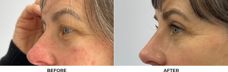 53 year old woman who was bothered by her upper eyelids appearance. She underwent upper blepharoplasty. After photos are 3 months post-surgery.				