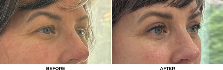 53 year old woman who was bothered by her upper eyelids appearance. She underwent upper blepharoplasty. After photos are 3 months post-surgery.				