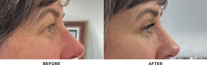 53 year old woman who was bothered by her upper eyelids appearance. She underwent upper blepharoplasty. After photos are 3 months post-surgery.				