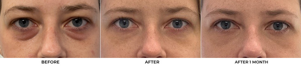 30 year old woman who was bothered by her upper and lower eyelid appearance. She underwent upper and lower eyelid blepharoplasty with fat grafting and CO2 resurfacing of the skin. After photos are shown at 1 month and 3 months post-surgery. Results can last 10 years.				