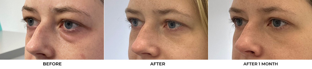 30 year old woman who was bothered by her upper and lower eyelid appearance. She underwent upper and lower eyelid blepharoplasty with fat grafting and CO2 resurfacing of the skin. After photos are shown at 1 month and 3 months post-surgery. Results can last 10 years.				