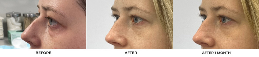 30 year old woman who was bothered by her upper and lower eyelid appearance. She underwent upper and lower eyelid blepharoplasty with fat grafting and CO2 resurfacing of the skin. After photos are shown at 1 month and 3 months post-surgery. Results can last 10 years.				