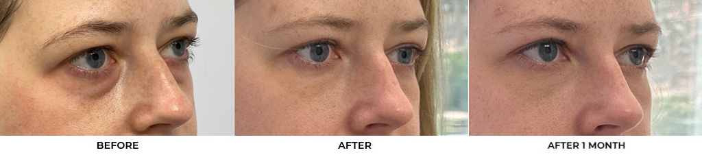 30 year old woman who was bothered by her upper and lower eyelid appearance. She underwent upper and lower eyelid blepharoplasty with fat grafting and CO2 resurfacing of the skin. After photos are shown at 1 month and 3 months post-surgery. Results can last 10 years.				