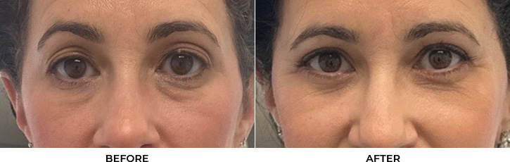 48 year old woman who was bothered by her upper and lower eyelid appearance. She underwent upper and lower eyelid blepharoplasty with fat transposition and skin pinch. After photos are shown at 3 months post-surgery. Results can last 10 years.				