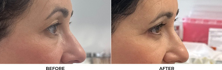 48 year old woman who was bothered by her upper and lower eyelid appearance. She underwent upper and lower eyelid blepharoplasty with fat transposition and skin pinch. After photos are shown at 3 months post-surgery. Results can last 10 years.				