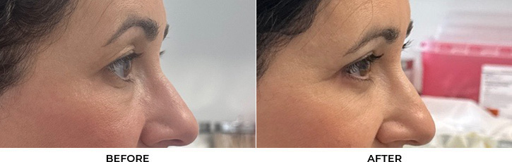 48 year old woman who was bothered by her upper and lower eyelid appearance. She underwent upper and lower eyelid blepharoplasty with fat transposition and skin pinch. After photos are shown at 3 months post-surgery. Results can last 10 years.				