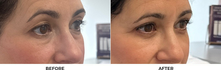 48 year old woman who was bothered by her upper and lower eyelid appearance. She underwent upper and lower eyelid blepharoplasty with fat transposition and skin pinch. After photos are shown at 3 months post-surgery. Results can last 10 years.				