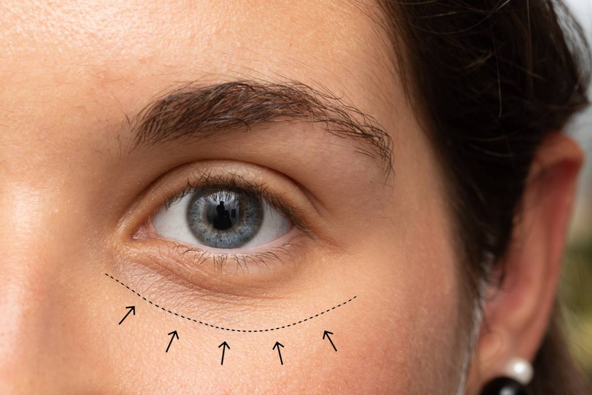 featured image for signs you need revision eyelid surgery