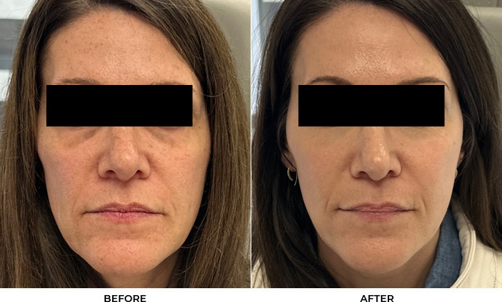 52 year old woman bothered by discoloration on face, chest, and shoulders. After photos obtained 1 month after a single BBL treatment.				