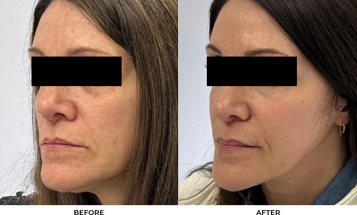 52 year old woman bothered by discoloration on face, chest, and shoulders. After photos obtained 1 month after a single BBL treatment.				