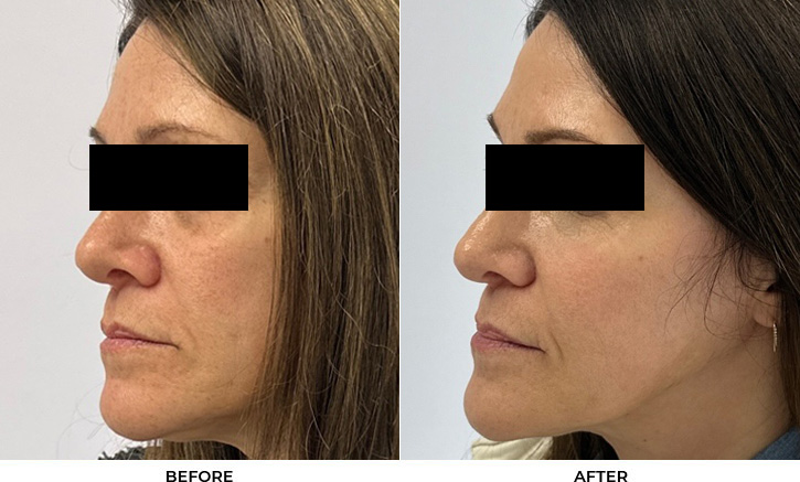 52 year old woman bothered by discoloration on face, chest, and shoulders. After photos obtained 1 month after a single BBL treatment.				