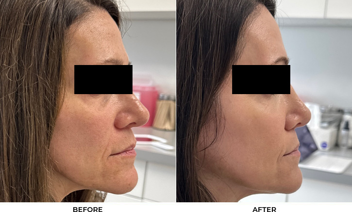 52 year old woman bothered by discoloration on face, chest, and shoulders. After photos obtained 1 month after a single BBL treatment.				