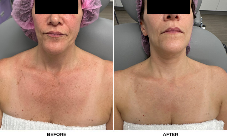 52 year old woman bothered by discoloration on face, chest, and shoulders. After photos obtained 1 month after a single BBL treatment.				