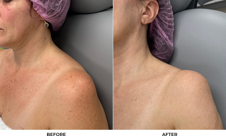 52 year old woman bothered by discoloration on face, chest, and shoulders. After photos obtained 1 month after a single BBL treatment.				