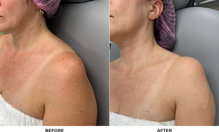 52 year old woman bothered by discoloration on face, chest, and shoulders. After photos obtained 1 month after a single BBL treatment.				