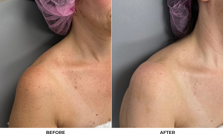 52 year old woman bothered by discoloration on face, chest, and shoulders. After photos obtained 1 month after a single BBL treatment.				