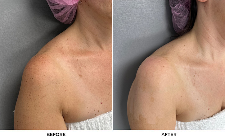 52 year old woman bothered by discoloration on face, chest, and shoulders. After photos obtained 1 month after a single BBL treatment.				