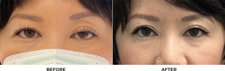 41 year old woman who was bothered by drooping of both upper eyelids. She underwent external ptosis repair. After photos are 2 months post-bilateral upper eyelid ptosis repair. Results can last 10 years.				