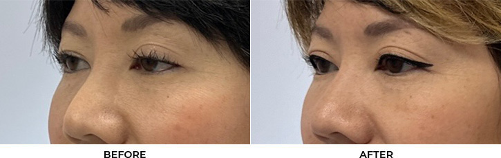 41 year old woman who was bothered by drooping of both upper eyelids. She underwent external ptosis repair. After photos are 2 months post-bilateral upper eyelid ptosis repair. Results can last 10 years.				