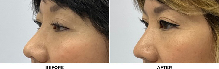 41 year old woman who was bothered by drooping of both upper eyelids. She underwent external ptosis repair. After photos are 2 months post-bilateral upper eyelid ptosis repair. Results can last 10 years.				