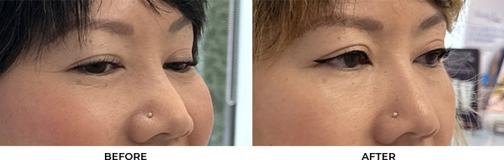 41 year old woman who was bothered by drooping of both upper eyelids. She underwent external ptosis repair. After photos are 2 months post-bilateral upper eyelid ptosis repair. Results can last 10 years.				