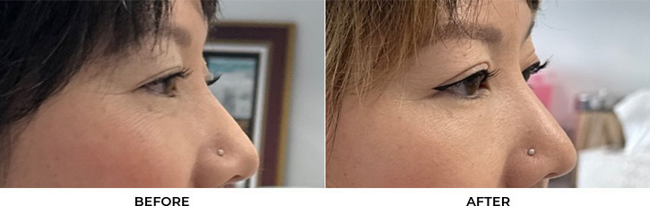 41 year old woman who was bothered by drooping of both upper eyelids. She underwent external ptosis repair. After photos are 2 months post-bilateral upper eyelid ptosis repair. Results can last 10 years.				