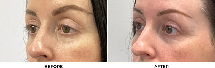44 year old woman who was bothered by drooping of both upper eyelids and excess skin of both upper eyelids. She underwent bilateral external ptosis repair and blepharoplasty. After photos are 1 month post-bilateral upper eyelid ptosis repair and blepharoplasty. Results can last 10 years.				