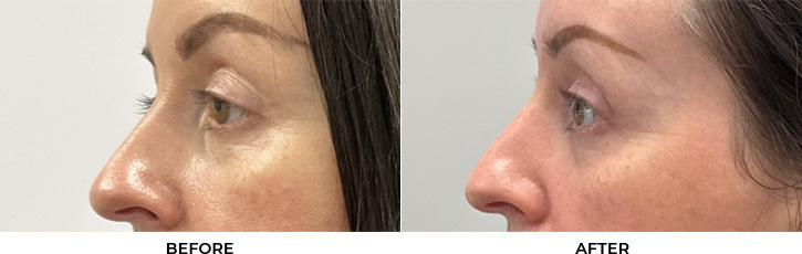 44 year old woman who was bothered by drooping of both upper eyelids and excess skin of both upper eyelids. She underwent bilateral external ptosis repair and blepharoplasty. After photos are 1 month post-bilateral upper eyelid ptosis repair and blepharoplasty. Results can last 10 years.				