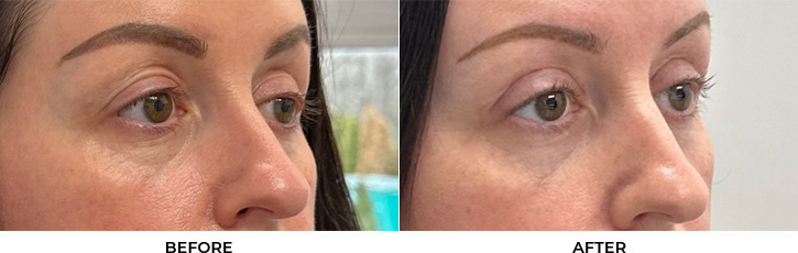 44 year old woman who was bothered by drooping of both upper eyelids and excess skin of both upper eyelids. She underwent bilateral external ptosis repair and blepharoplasty. After photos are 1 month post-bilateral upper eyelid ptosis repair and blepharoplasty. Results can last 10 years.				