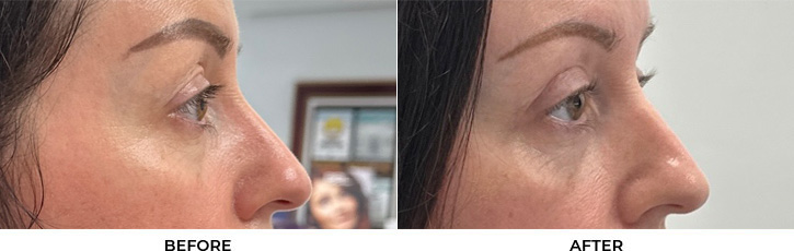 44 year old woman who was bothered by drooping of both upper eyelids and excess skin of both upper eyelids. She underwent bilateral external ptosis repair and blepharoplasty. After photos are 1 month post-bilateral upper eyelid ptosis repair and blepharoplasty. Results can last 10 years.				