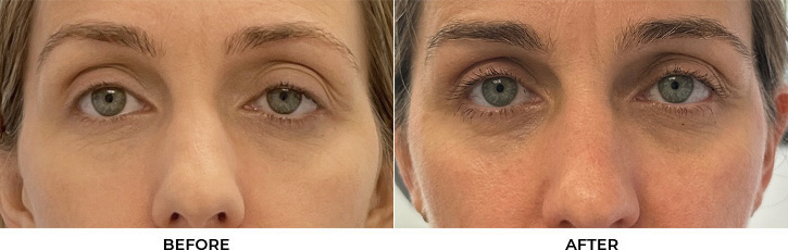 47 year old woman who was bothered by drooping of the left upper eyelid. She underwent internal ptosis repair. After photos are 9 months post-left upper eyelid internal ptosis repair. Results can last 10 years.				