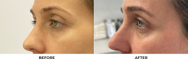 47 year old woman who was bothered by drooping of the left upper eyelid. She underwent internal ptosis repair. After photos are 9 months post-left upper eyelid internal ptosis repair. Results can last 10 years.				